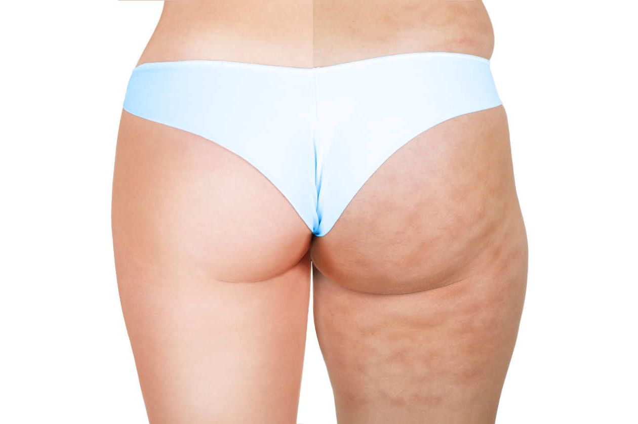 Mesoterapia en Madrid